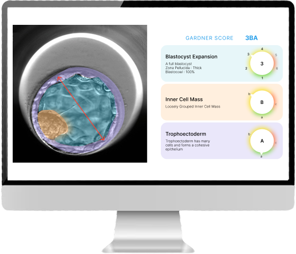 Blastocyst image with the inner cell mass and blastocoel segmented in colour, beside a Gardner score of 3BA broken into blastocyst expansion 3, inner cell mass B and trophectoderm A.