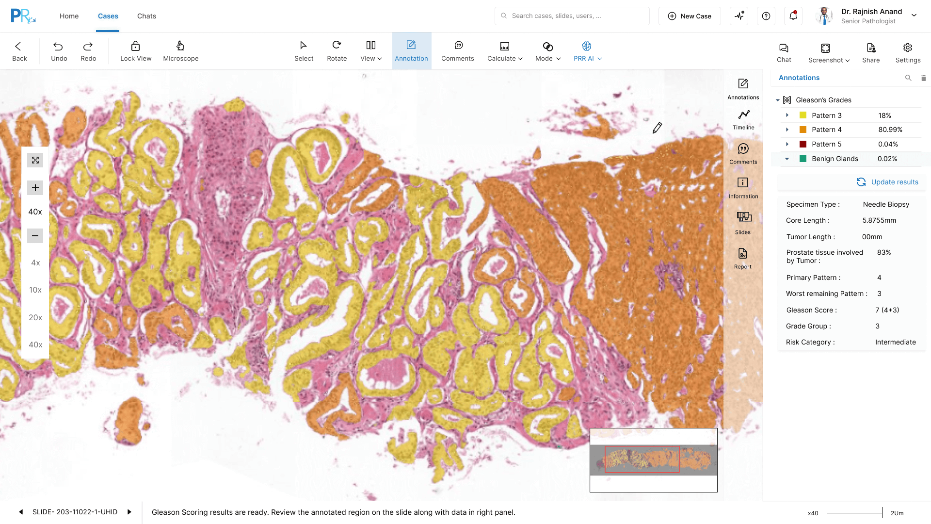 Prostate needle biopsy at 40x with Gleason pattern 3 in yellow, pattern 4 in orange and pattern 5 in red overlaid on the tissue. A side panel reports pattern 3 at 18 percent, pattern 4 at 80.99 percent, core length 5.8755mm, Gleason score 7 (4+3), grade group 3 and intermediate risk.