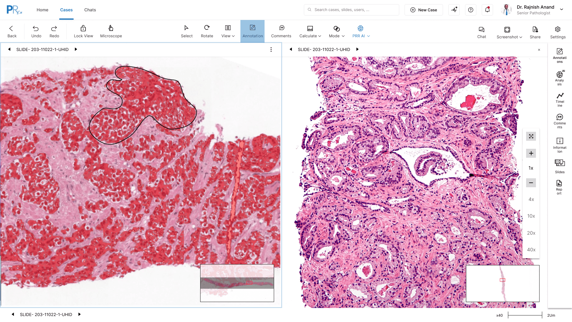PathVu multiview showing one slide in two synchronised panels at different stains and magnifications, with a freehand annotation around a region of interest.